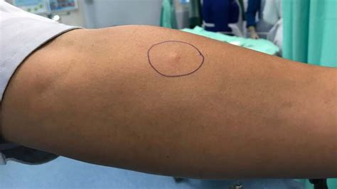 what does a positive tb test look like|TB Tests: Types of Tuberculosis Tests and Results .